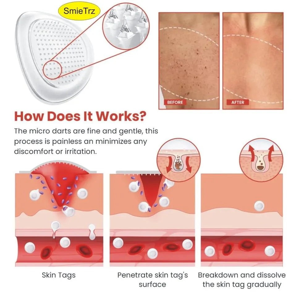 Derma Smooth Skin Tag Remover 72 Patches